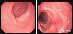 萎縮性胃炎不可怕，只要