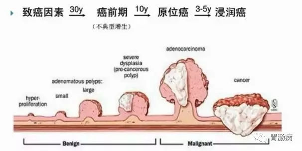 體檢查出腸息肉一定要切除！ 95%腸癌由它演變而來
