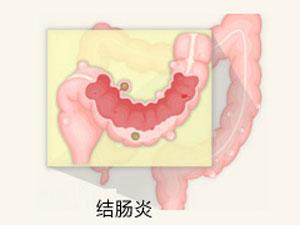 南寧治療結腸炎醫(yī)院哪家好