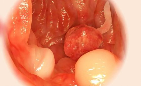 南寧直腸息肉手術多少錢